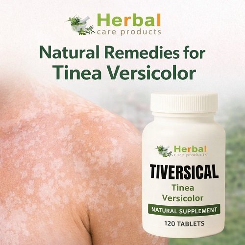 Natural-Remedies-for-Tinea-Versicolor.jpg